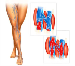 Prueba de Brodie-Trendelemburg para detectar la insuficiencia valvular venosa