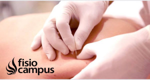 Efectividad de la punción seca