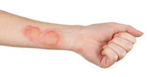 Fisioterapia en pacientes quemados