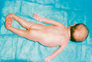 Artrogriposis múltiple congénita infantil: diagnóstico, causas y tratamiento en fisioterapia