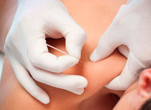 Síndrome del túnel del carpo: tratamiento de puntos gatillo con punción seca