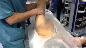 Tratamiento de manipulación traslacional bajo anestesia en capsulitis adhesiva de hombro. ¿El mejor abordaje terapéutico?