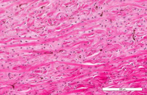 Dolor tendinoso en el miembro inferior: 10 tratamientos a evitar