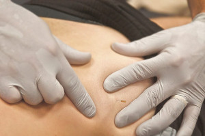 Eficacia de la punción seca en el tratamiento del síndrome de dolor miofascial