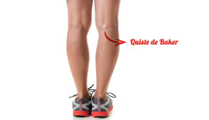 Quiste de Baker: origen y complicaciones