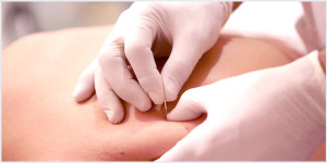 Beneficios  de la punción seca en el Síndrome de Dolor Miofascial Cervical