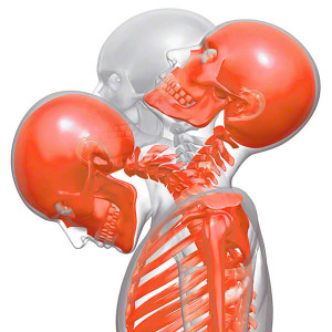 Whiplash o latigazo cervical: Abordaje Osteopático